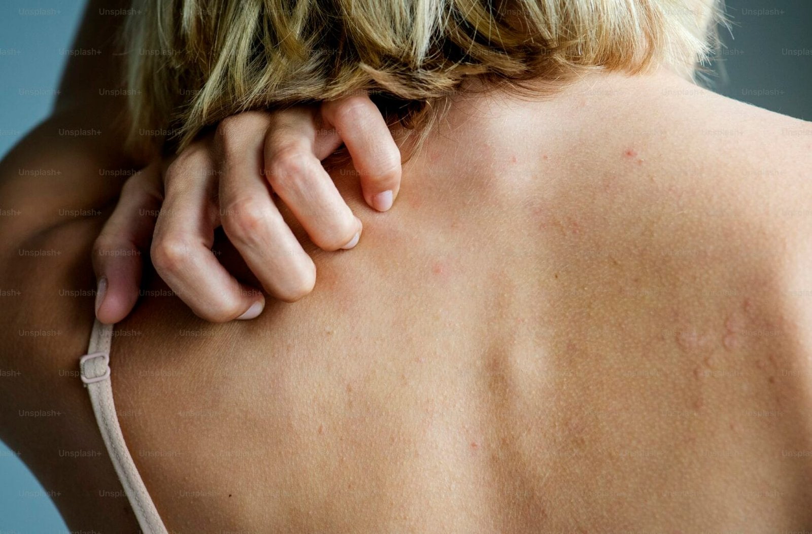 Shingles