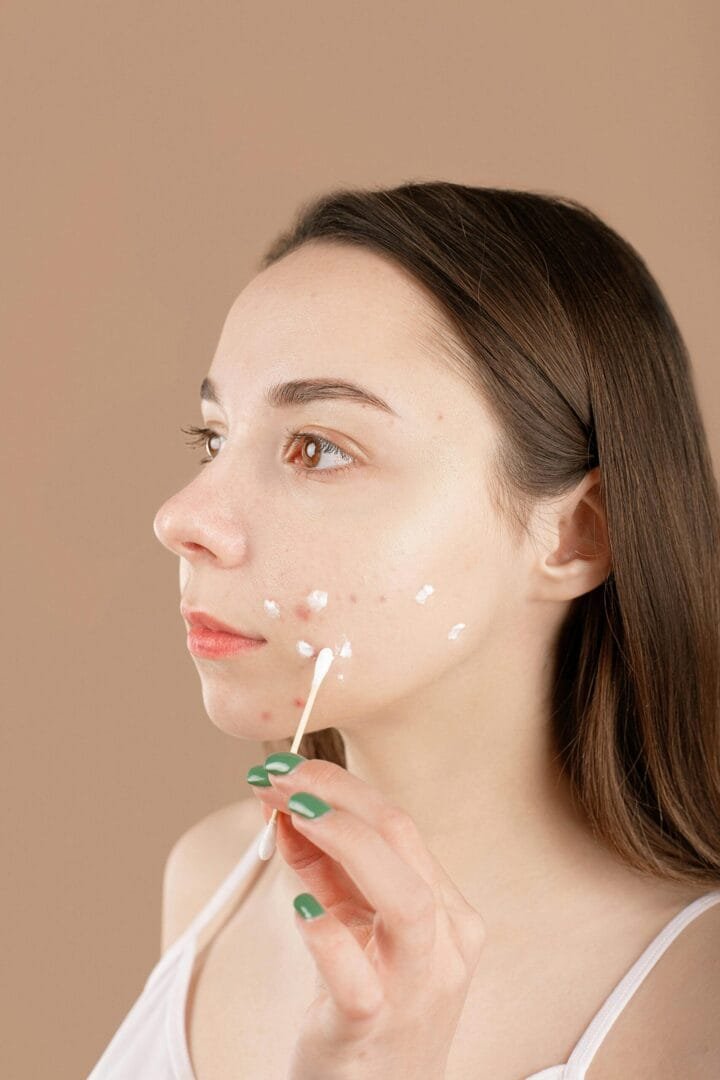 Acne Treatment