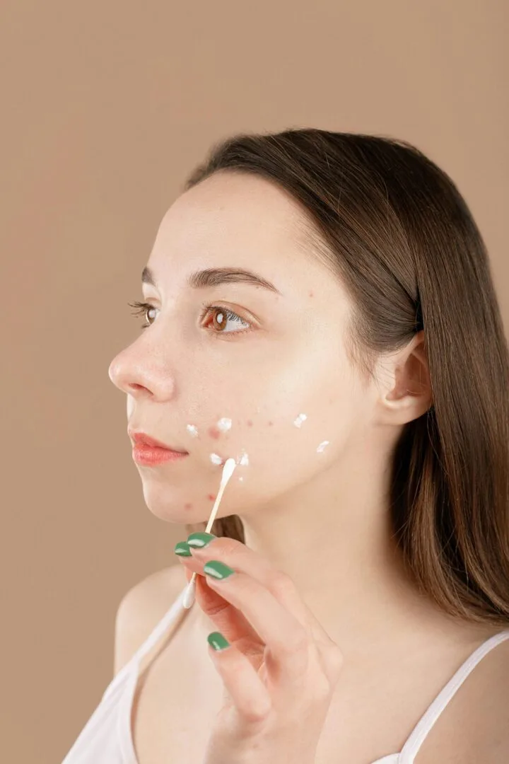 Acne Treatment
