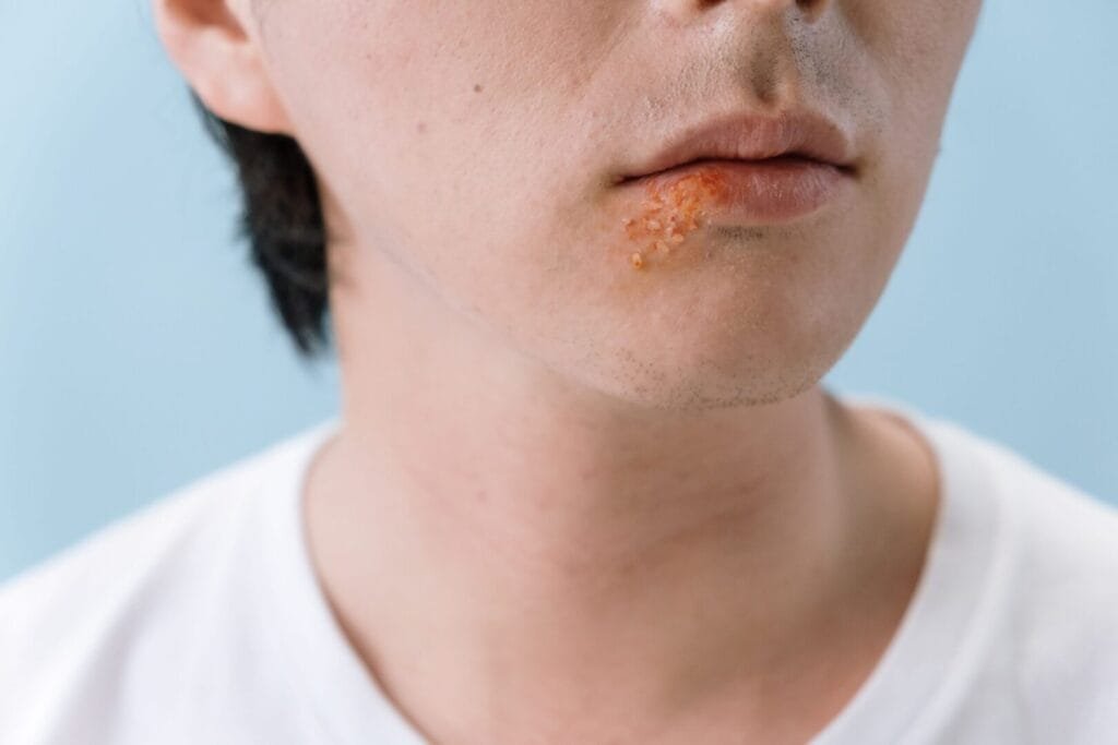 What Are the First Signs of Impetigo? at The Kingston Pharmacy, Kingston upon Thames