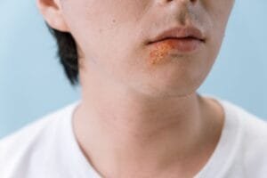 What Are the First Signs of Impetigo? at The Kingston Pharmacy, Kingston upon Thames