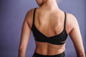 Shingles vs Other Common Skin Rashes: What’s the Difference? at The Kingston Pharmacy, Kingston upon Thames
