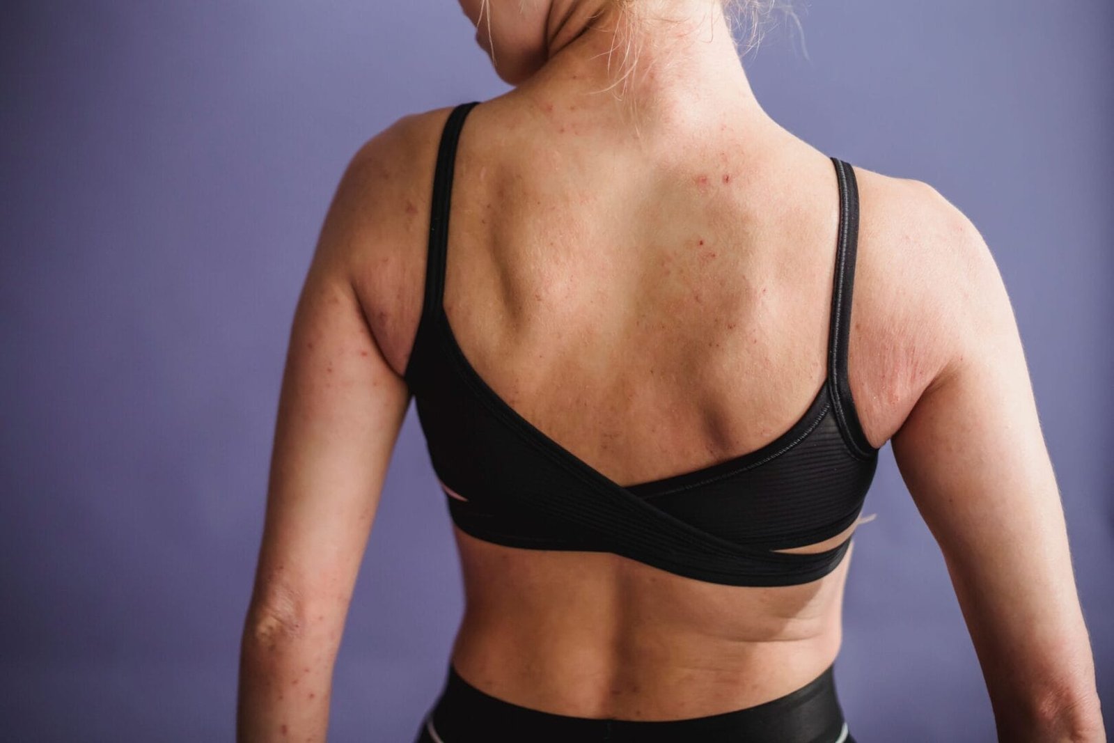 Shingles vs Other Common Skin Rashes: What’s the Difference?
