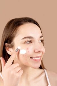 Treclin Gel Explained: A Guide to One of the Most Effective Prescription Acne Treatments at The Kingston Pharmacy, Kingston upon Thames