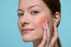 Why Is My Face Always Red? Could It Be Rosacea? at The Kingston Pharmacy, Kingston upon Thames
