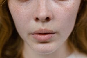 10 Everyday Triggers That Could Be Making Your Rosacea Worse at The Kingston Pharmacy, Kingston upon Thames